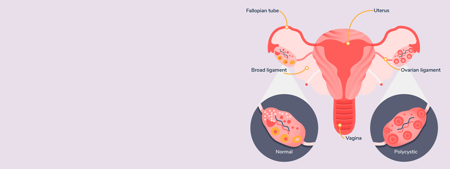 Top 10 Natural Treatments For Managing PCOD And PCOS